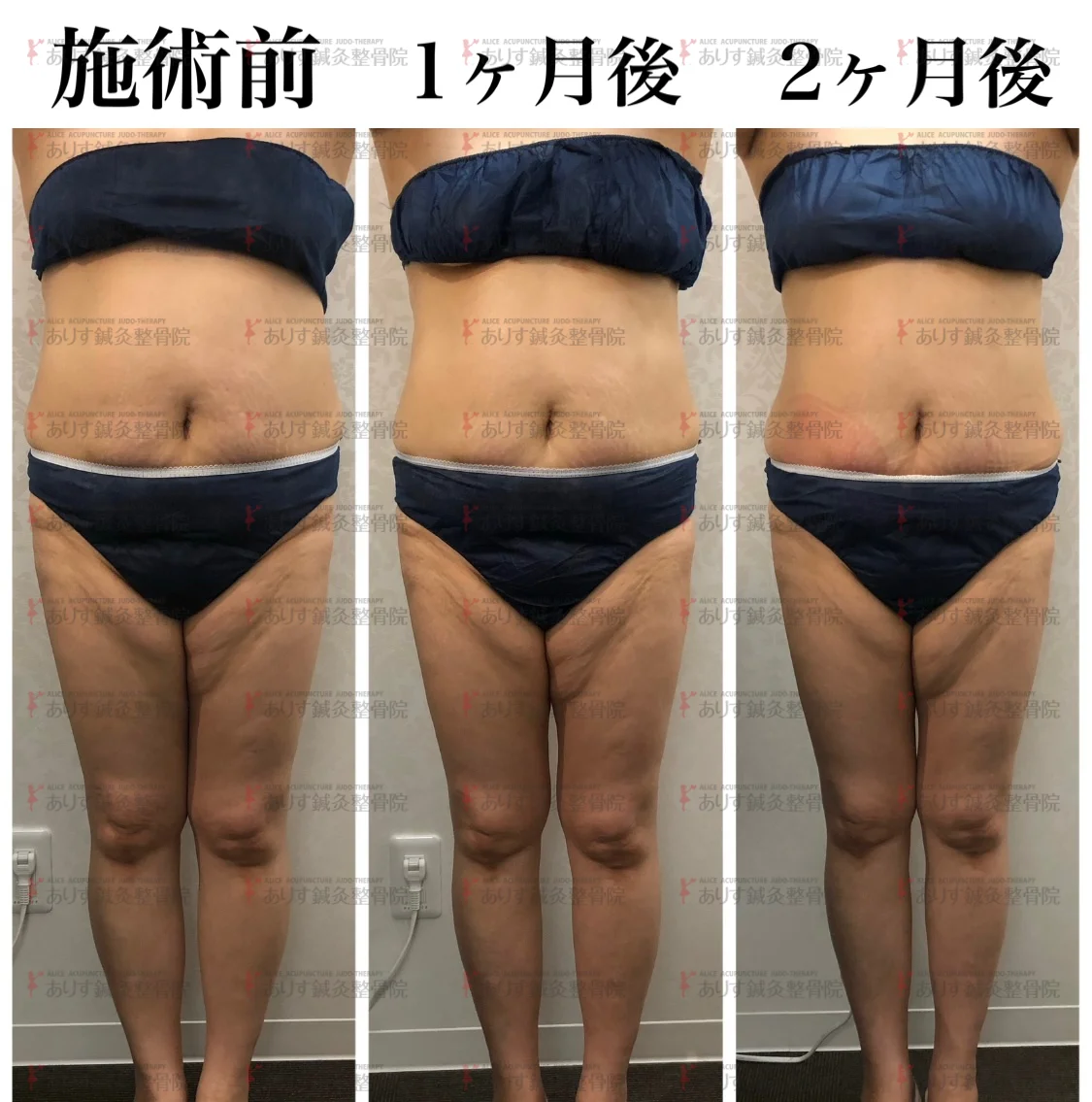 脂肪冷却　吸引カップ 脂肪冷却 吸引カップ｜Yahoo!フリマ（旧PayPayフリマ）